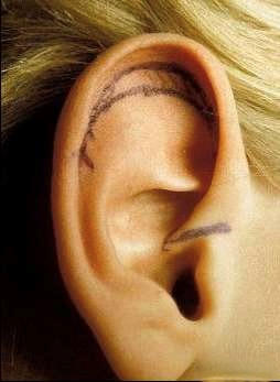 Operación reducción orejas